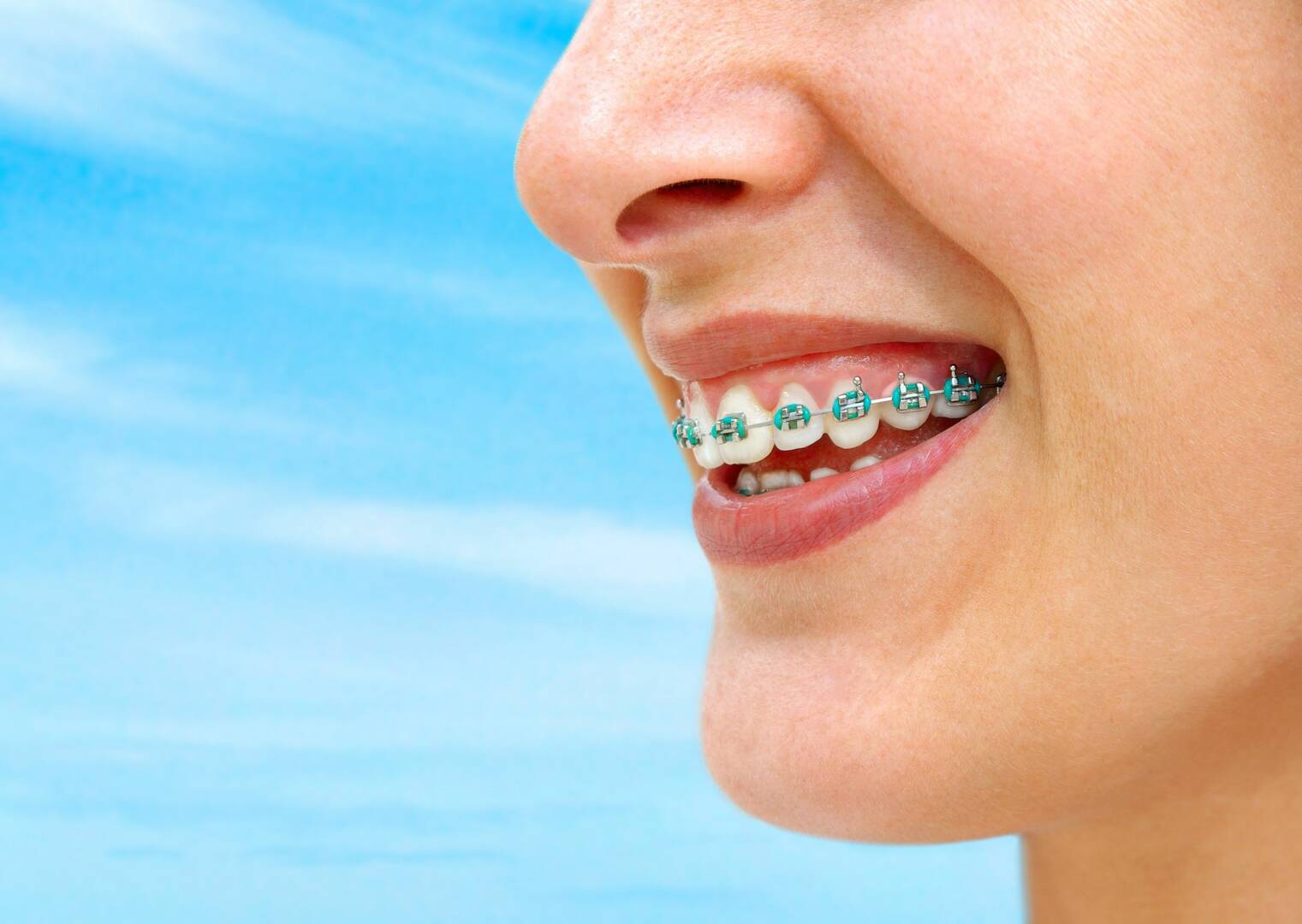 Teeth Whitening Kelowna